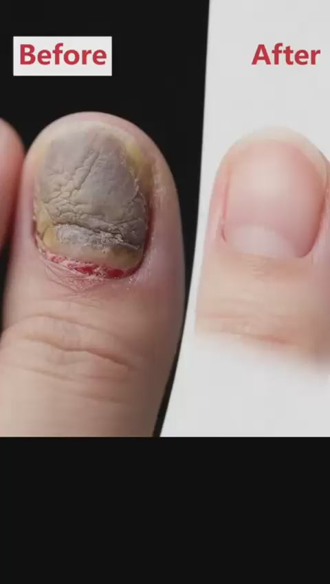 Fungal Nail Patches video