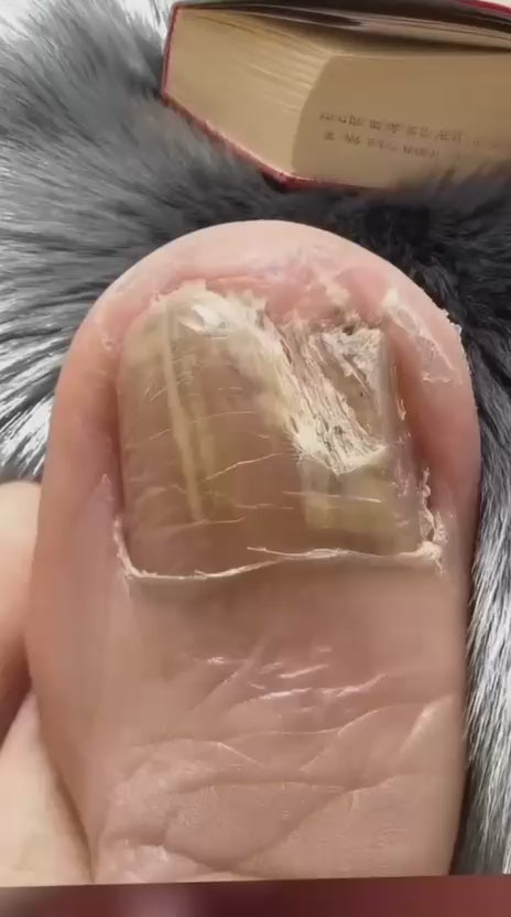 Fungal Nail Patches video